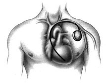 Pacemaker Attorney - Philadelphia - Pennsylvania