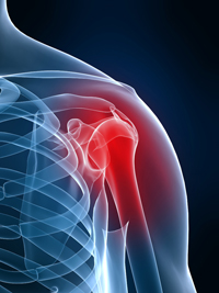 Shoulder surgery pain pum attorneys - Philadelphia, Pennsylvania, New Jersey and Delaware