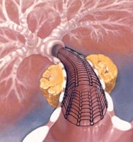 stent