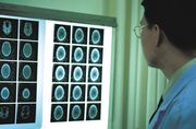 Brain Injury 0