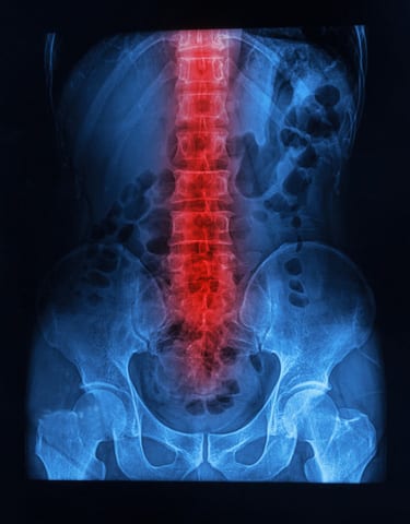 spinal abcess2