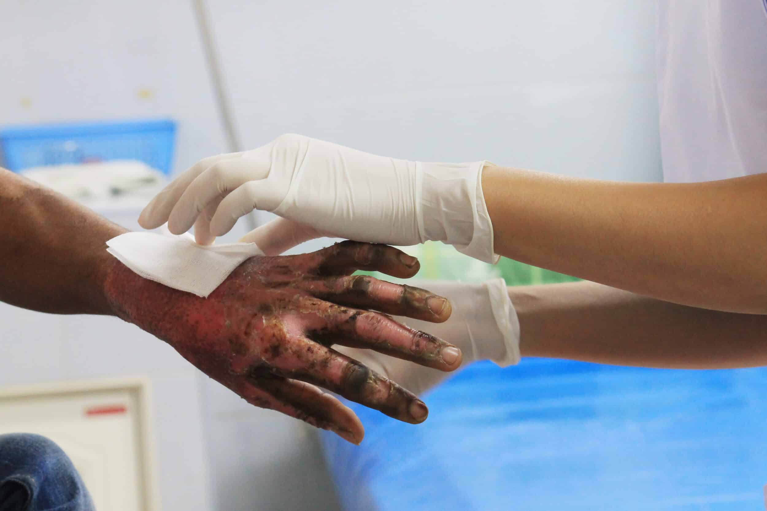 A doctor bandaging a burn injury victim's hand